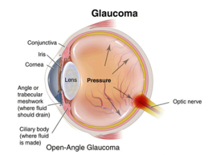 glaucoma13